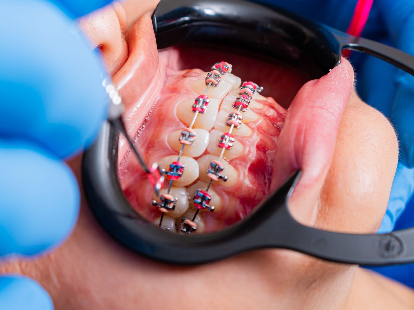 Braces at RC's Dentcare, Upper Bazar, Ooty