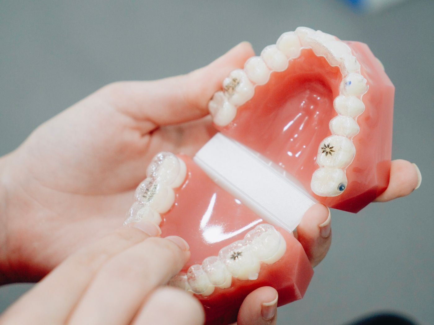 Metal braces with brackets bonded to upper teeth and an archwire in place