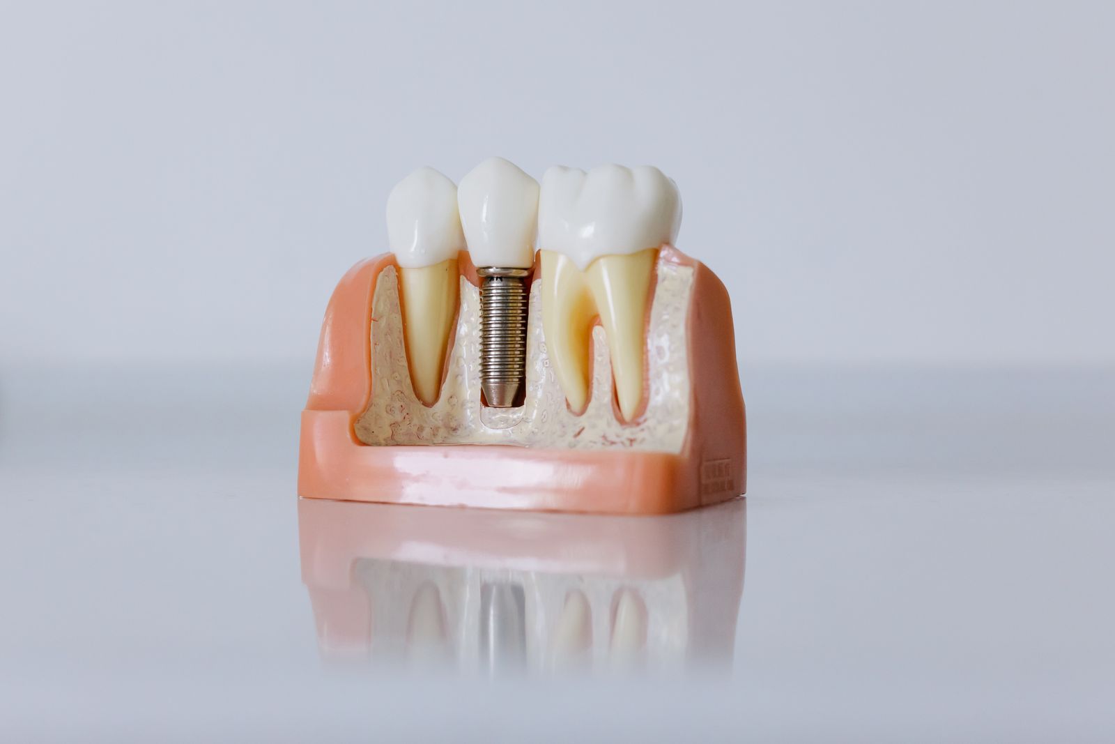 Close-up dental implant model showing an implant fixture placed in the jaw