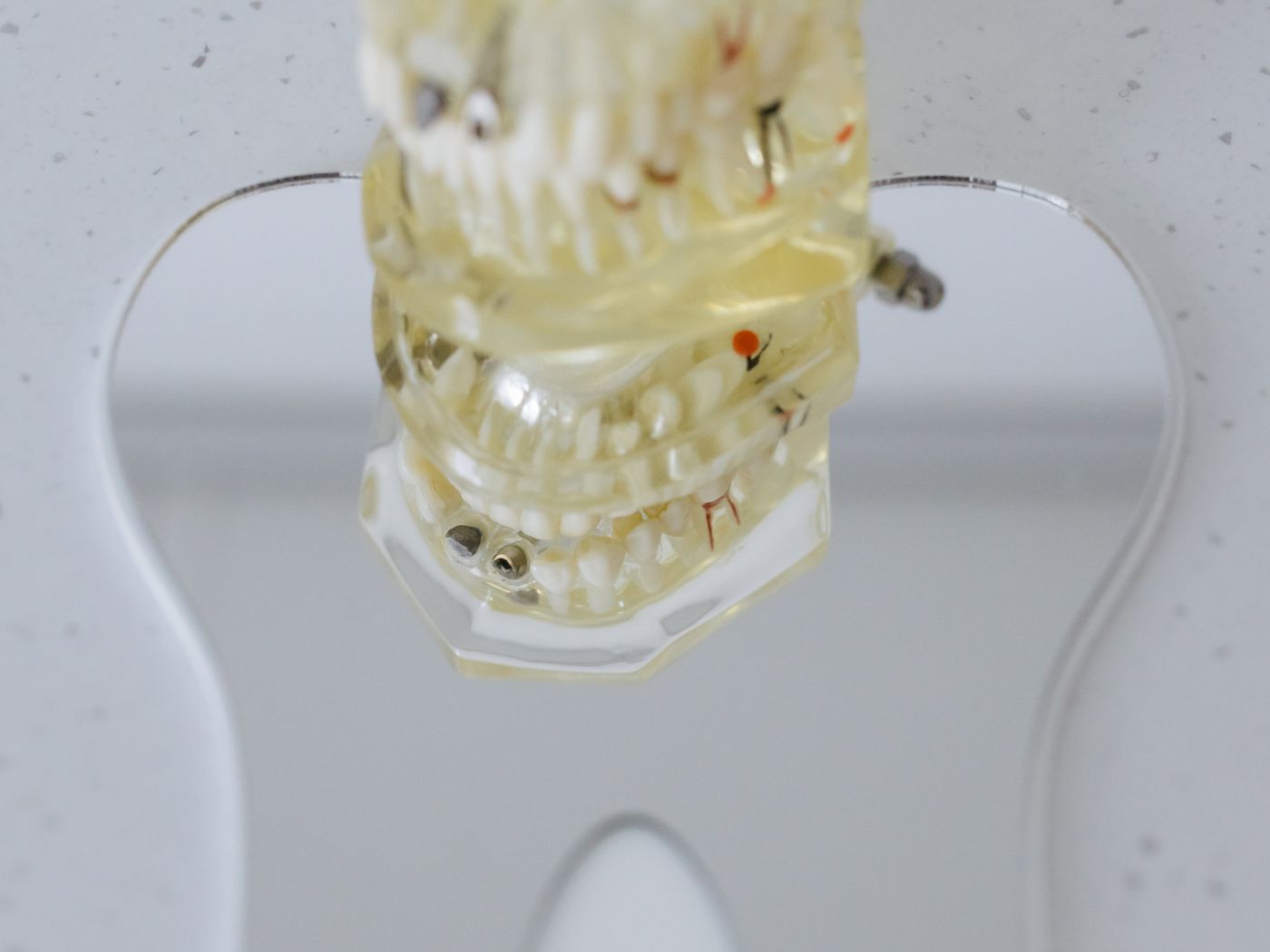 Extractions at RC's Dentcare, Upper Bazar, Ooty