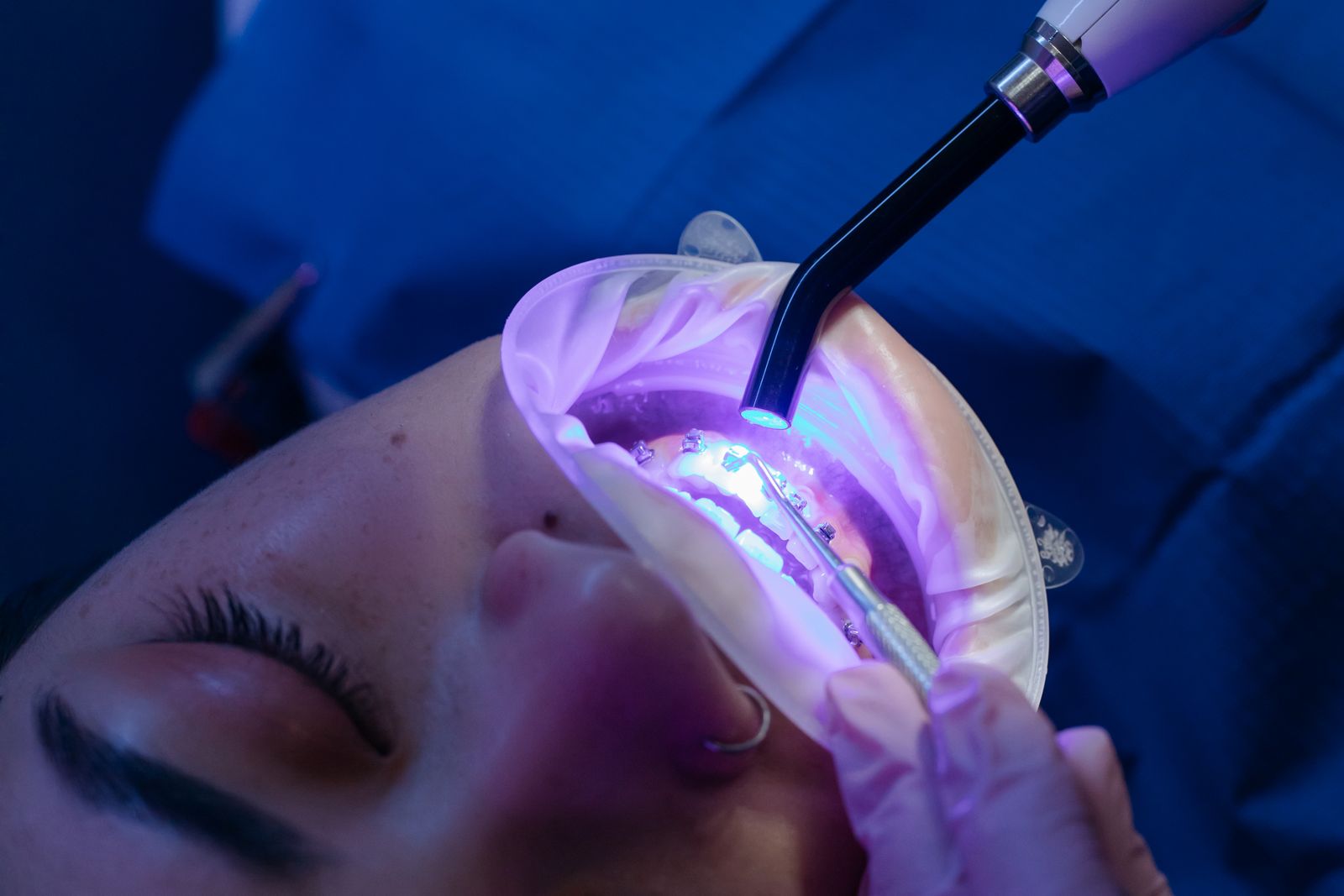 Laser Dentistry at RC's Dentcare, Upper Bazar, Ooty