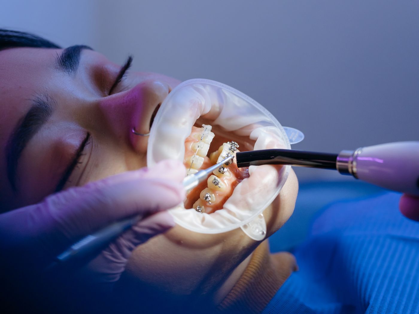 Orthodontics at RC's Dentcare, Upper Bazar, Ooty