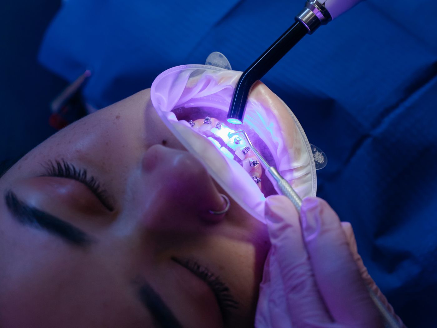 Close-up of teeth fitted with metal orthodontic brackets and archwire