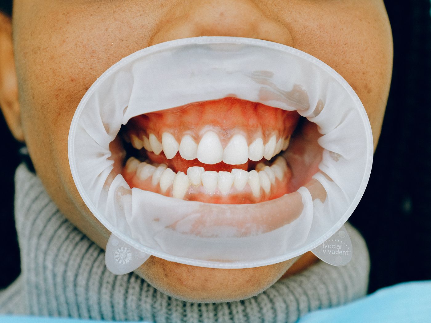 Close-up of a professional gum and teeth cleaning procedure in progress