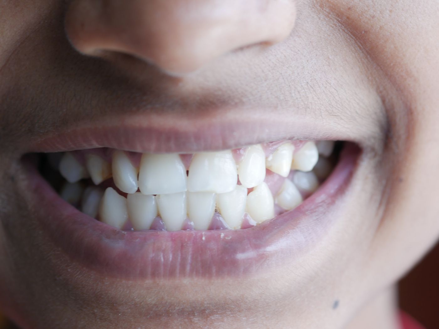 Close-up of teeth with an even, natural shade after professional whitening