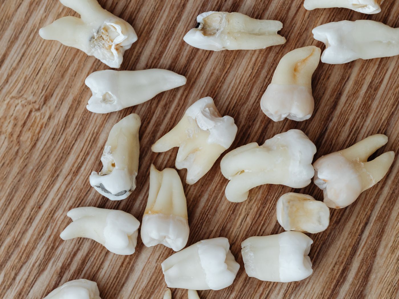 Veneers & Crowns at RC's Dentcare, Upper Bazar, Ooty