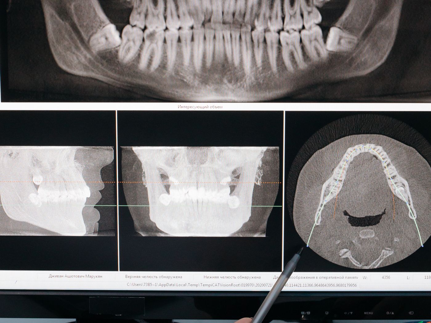 Panoramic dental radiograph displayed on a backlit clinical screen